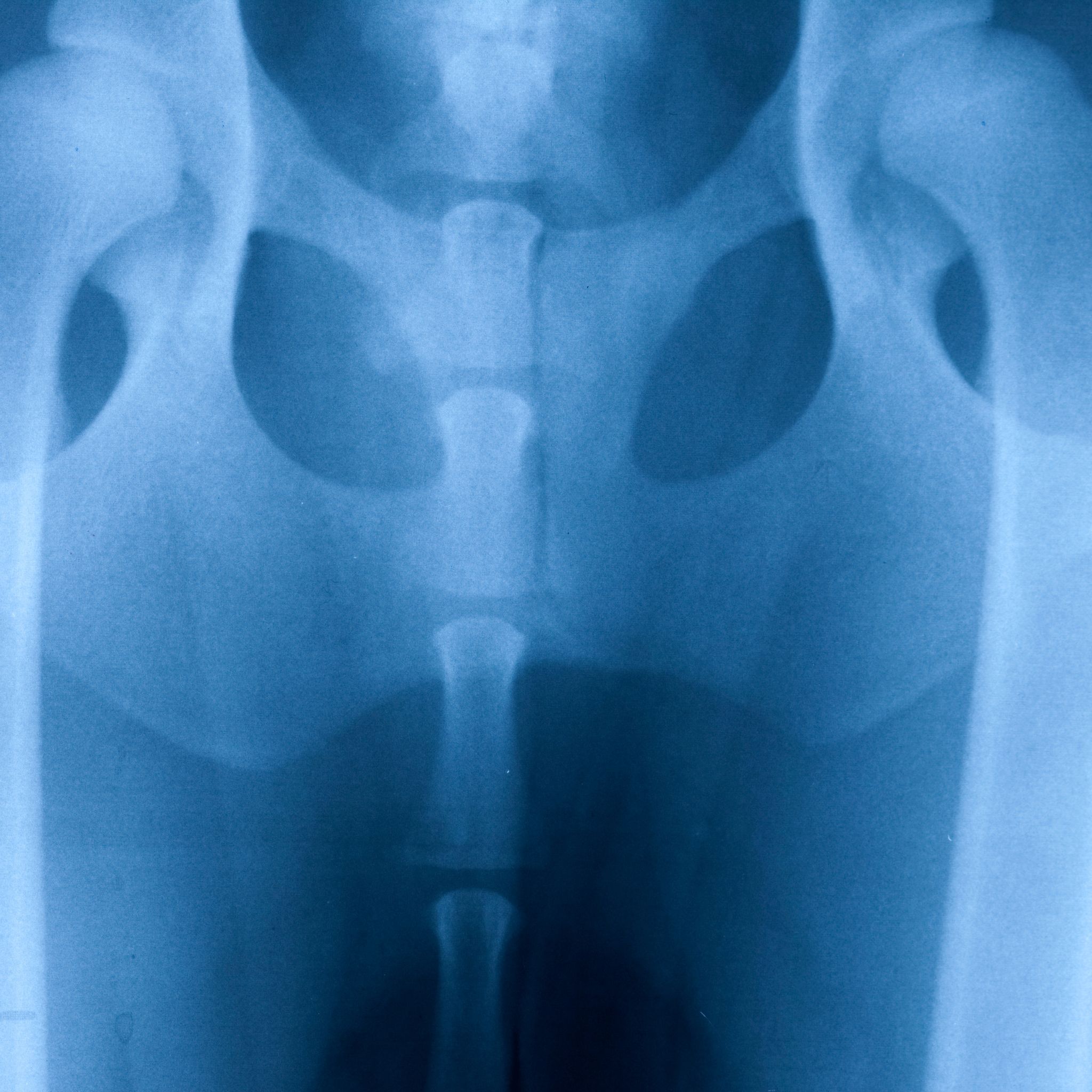 Dog with hip dislocation surgery in vets of melbourne